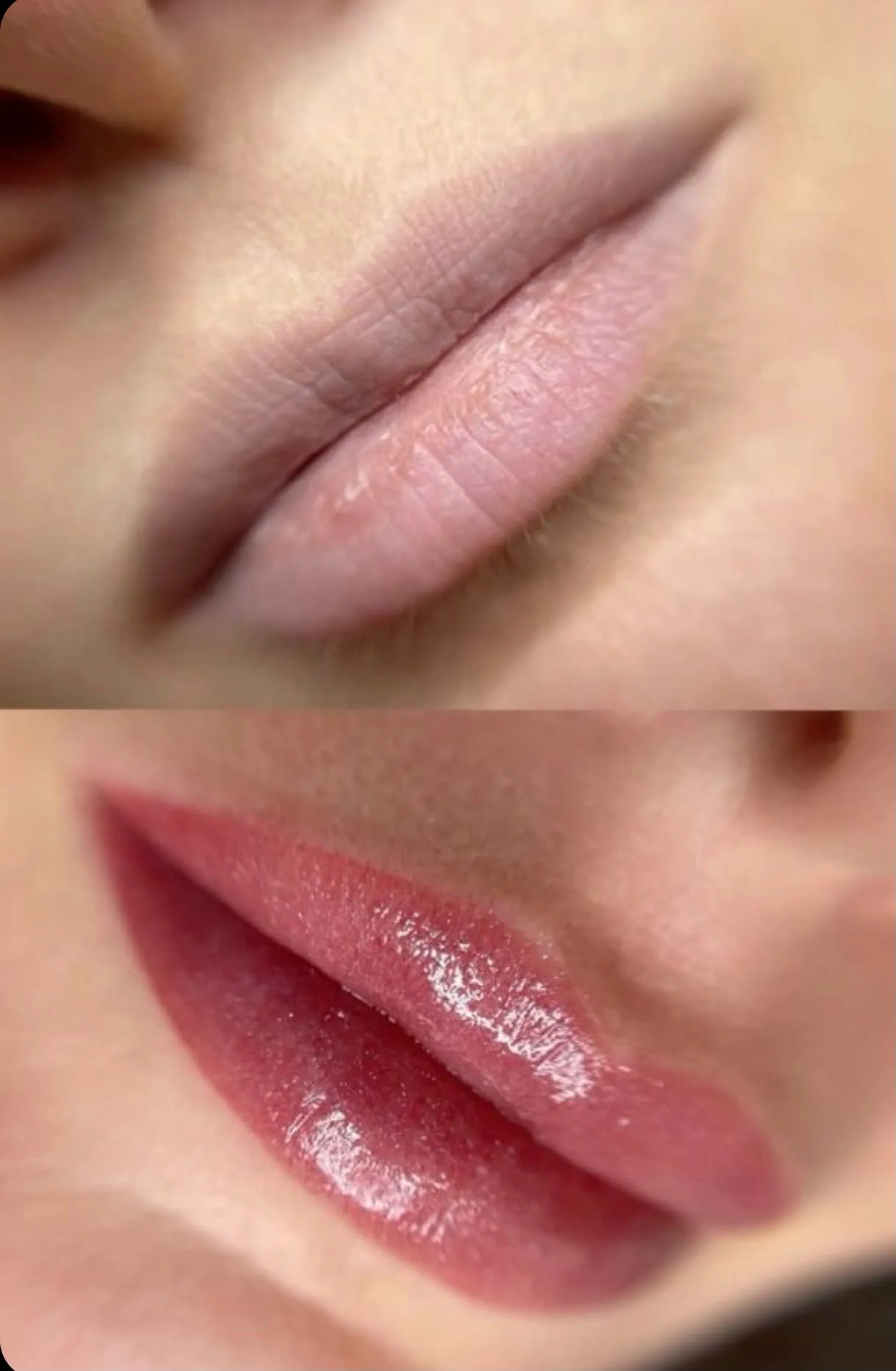 Resultado de tratamiento de labios